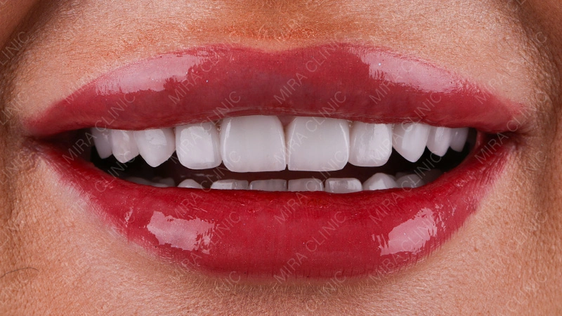 minimal-prep veneers